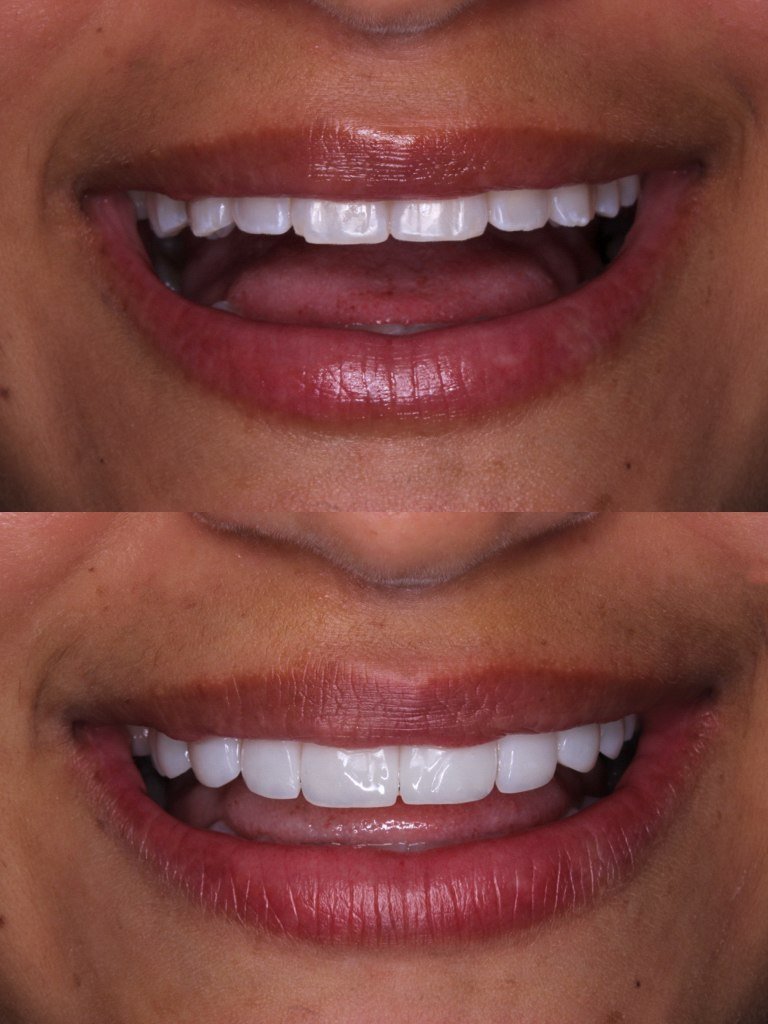 Resultado de lentes em resina - antes e depois