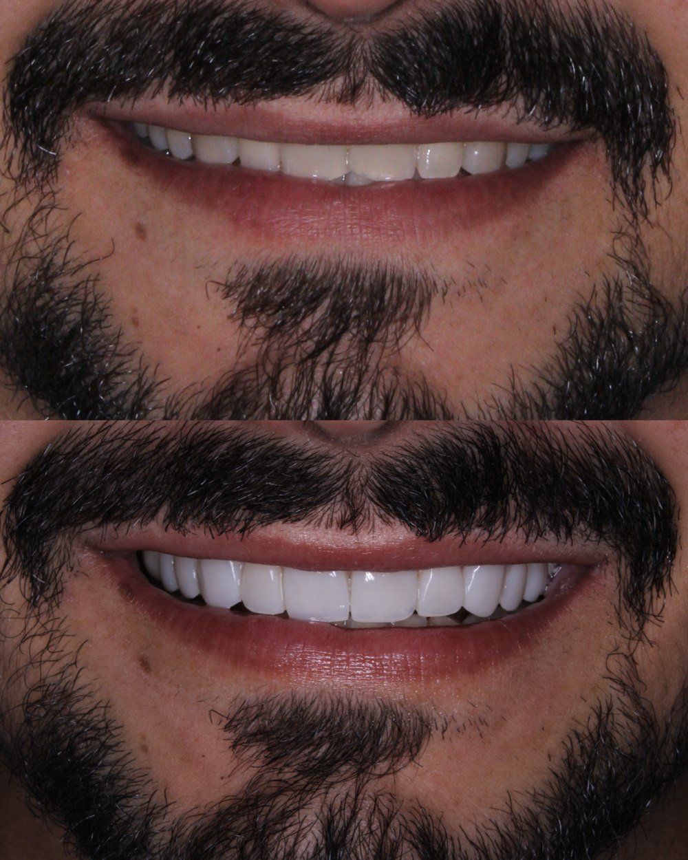Resultado de lentes em resina - antes e depois