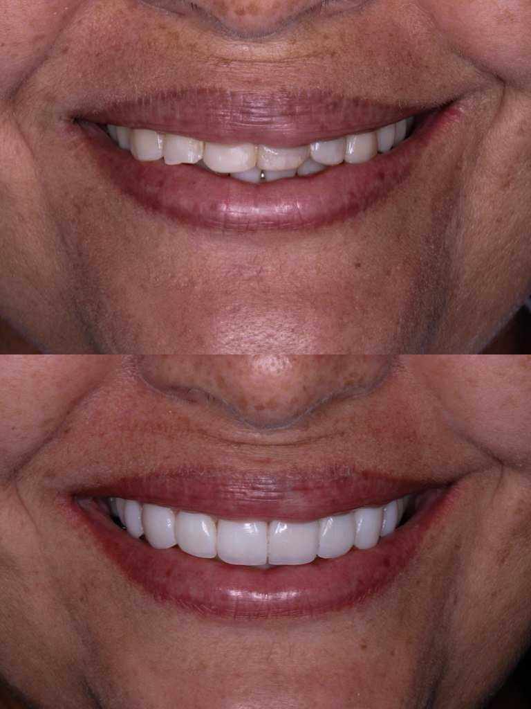 Resultado de lentes em resina - antes e depois