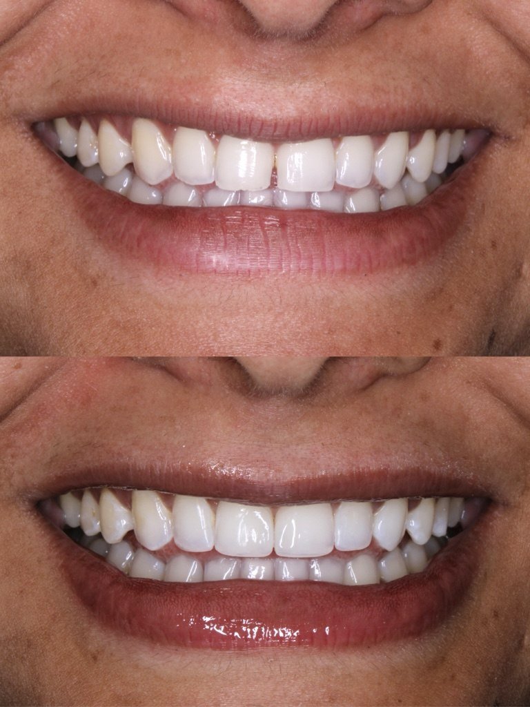 Resultado de lentes em resina - antes e depois