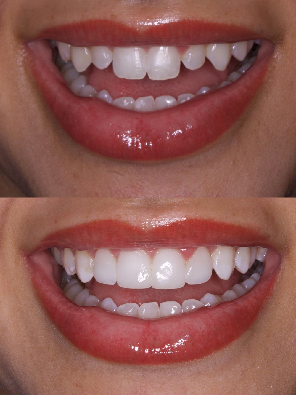 Resultado de lentes em resina - antes e depois